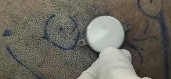 China successfully conducts clinical trial for invasive brain-computer interface