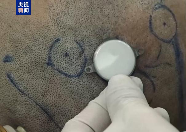 China successfully conducts clinical trial for invasive brain-computer interface