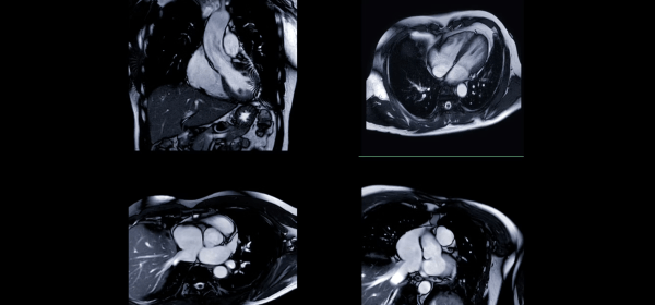 AI can guess racial categories from heart scans – what it means and why it matters