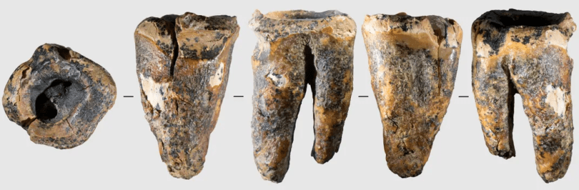 The Neanderthal dentist who worked on the 59,000-year-old molar had some experience treating cavities.